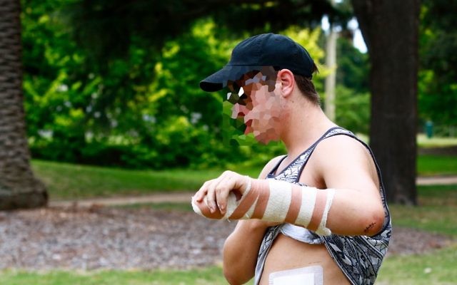 The victim shows his injuries following last week's attack. Photo: Peter Haskin