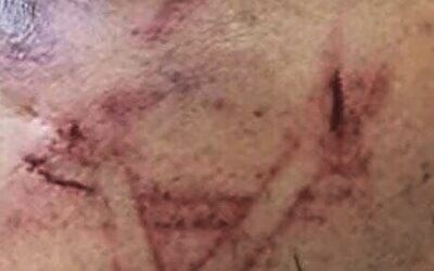 The marks on a detainee's face. Photo: Israel Police