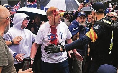 An injured protester during the 
"March for Australia" anti-immigration rally in Melbourne. 
	Photo: William WEST/AFP