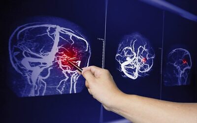 A doctor points to a brian scan image of a recent traumatic brain injury. 
Photo: Rattanachot2525/Dreamstime.com