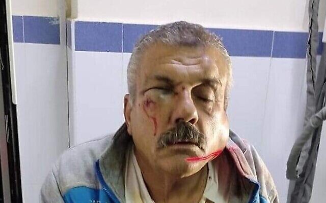 وائل مقبل، من سكّان قرية قريوت، بعد تعرضه للاعتداء من قبل مستوطنين متطرفين في 17 كانون الأول 2021 (Courtesy)