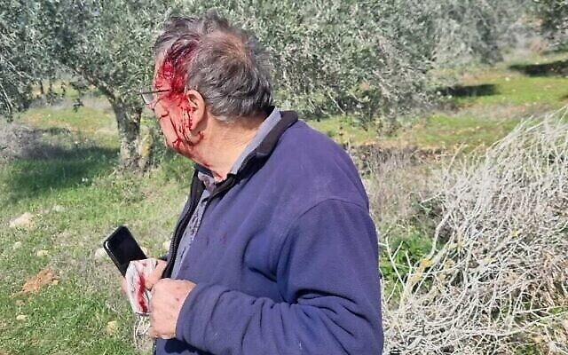 ناشط إسرائيلي، سقط دمه جراء ضربه على يد متطرفين يهود في الضفة الغربية بالقرب من البؤرة الاستيطانية غفعات رونين، يوم الجمعة، 21 يناير، 2022 (Courtesy: Yesh Din)