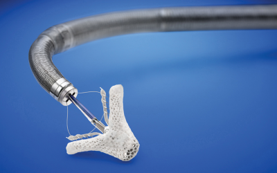 A MitraClip like this one attached to a surgical catheter is inserted into the heart to improve valve functioning.