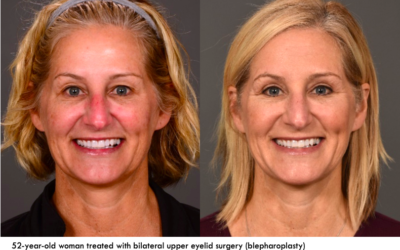 One of Dr. Fishman’s patients, before and after upper eyelid surgery.