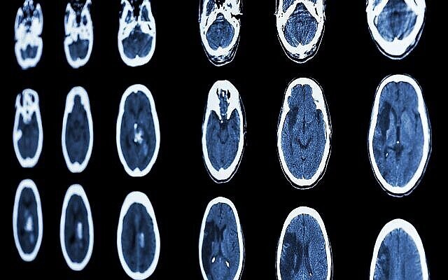 تصویر تزئینی: سی تی اسکن مغز، سکتهٔ ایسکمیک و سکتهٔ همورژیک را نشان می دهد. 
(stockdevil; iStock by Getty Images)