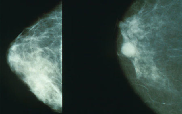 Mammographie normale (à gauche) ou présentant un cancer du sein (à droite). (Crédit : domaine public/NIH/WikiCommons)