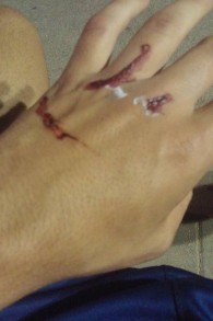 Les blessures d'un adolescent israélien après avoir été attaqué par un gang arabe avec une bouteille cassée dans le sud de Tel Aviv, le 21 juin 2016. (Crédit : Facebook/Sahar Tusia)