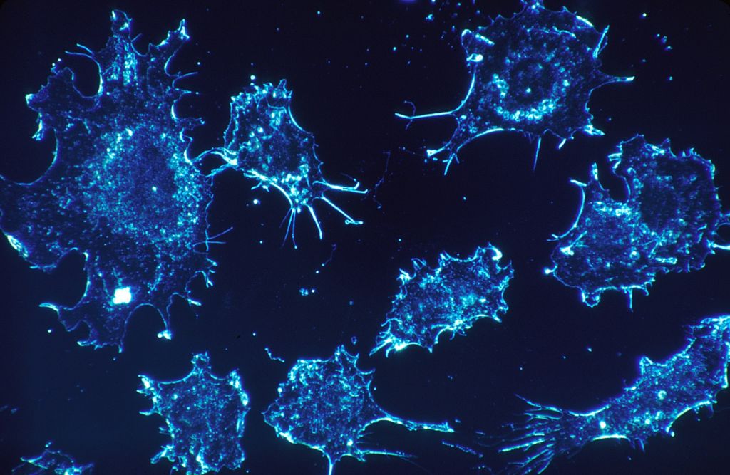 Photo d'illustration de cellules cancéreuses (Crédit : Pixabay)