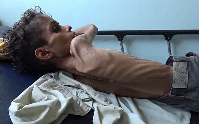 Ghazi Saleh, 8 kilos pour 10 ans, dans un lit d'hôpital de Taez au Yémén, le 19 novembre 2018. (Crédit : Marzooq AL-JABIRY / AFP)