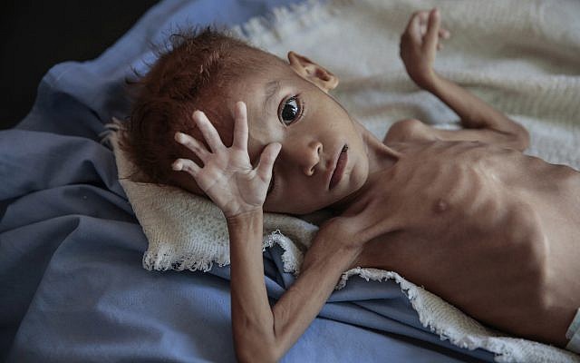 Un enfant souffrant de malnutrition pris en charge à l’hôpital Aslam Health Center, à Hajjah, au Yemen, le 1 octobre 2018. (Crédit : AP/Hani Mohammed)