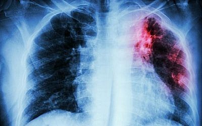 Image de la poitrine d'une patient atteint d'une tuberculose pulmonaire. (stockdevil; iStock par Getty Images)
