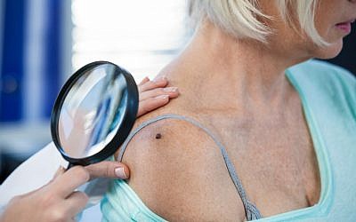 Image d'un dermatologue qui vérifie un grain de beauté d'un patient pour détecter des signes d'un mélanome. (Crédit : iStock par Getty Images)