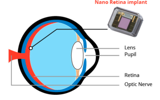 Schéma du dispositif NR600 de la société israélienne Nano Retina. (Crédit : Nano Retina Ltd.)