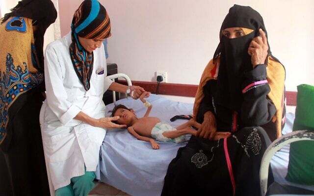 Une employée médicale examine un enfant yéménite souffrant de malnutrition, dans un centre de traitement de la province de Hajjah, dans le nord du Yémen, le 5 juillet 2020. (ESSA AHMED / AFP)