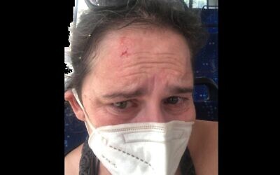 Sarah Nadav, peu après son agression dans un bus de Tel Aviv (Autorisation : Sarah Nadav)