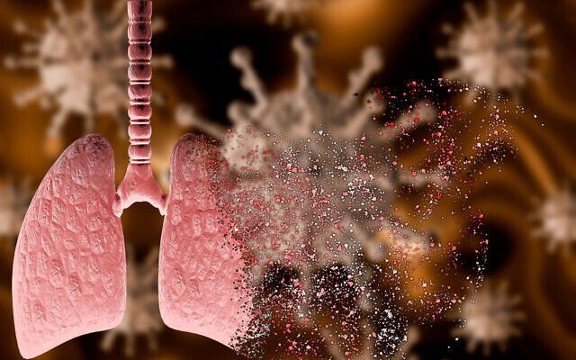 Image illustrative : Rendu 3D du coronavirus attaquant un poumon atteint de pneumonie sévère. (iStock)
