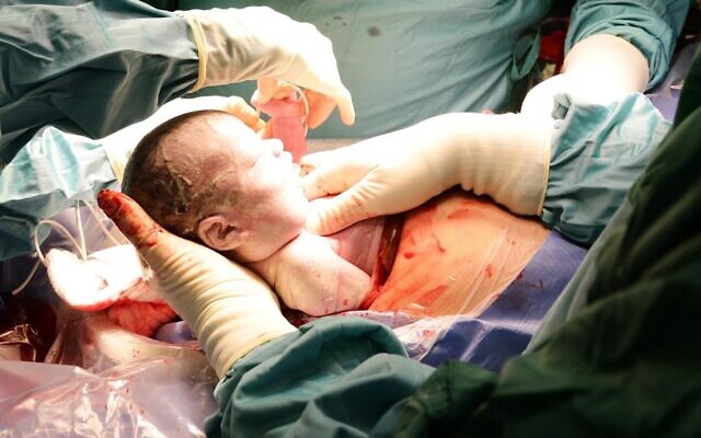 Le bébé né le 14 octobre 2020, après une procédure ex utero intrapartum au Centre médical Sourasky de Tel Aviv (avec l'aimable autorisation du Centre médical Sourasky de Tel Aviv)
