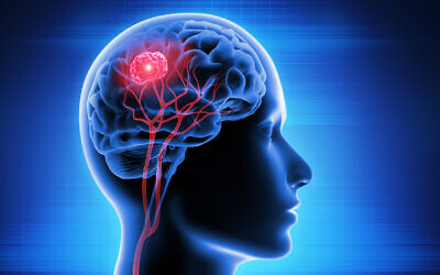 Illustration d'une tumeur cérébrale causée par un glioblastome. (peterschreiber.media via iStock by Getty Images)