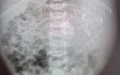 Radiographie de l'estomac d'un nouveau-né, une petite fille, dans lequel on a découvert un embryon, le 20 juillet 2021. (Centre médical d'Assuta)
