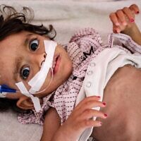 Un enfant souffrant de malnutrition reçoit un traitement à l'hôpital Al-Sadaqa dans la ville d'Aden, dans le sud du Yémen, le 26 février 2022. (Crédit : Saleh OBAIDI / AFP)