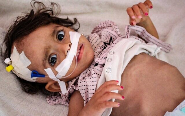 Un enfant souffrant de malnutrition reçoit un traitement à l'hôpital Al-Sadaqa dans la ville d'Aden, dans le sud du Yémen, le 26 février 2022. (Crédit : Saleh OBAIDI / AFP)