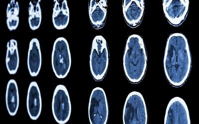 Un scanner illustratif d'un cerveau montre un AVC ischémique et un AVC hémorragique. (Crédit: stockdevil; iStock par Getty Images)