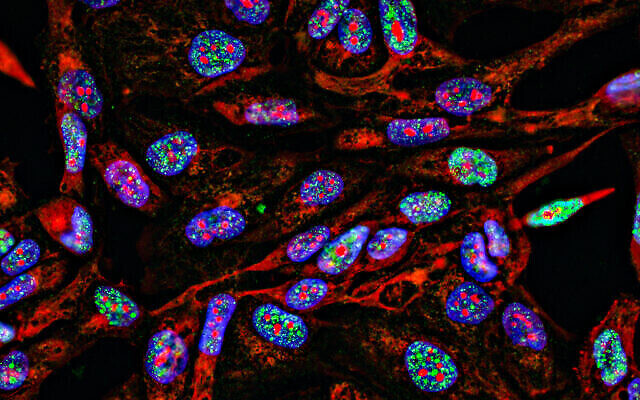 Immunofluorescence des cellules cancéreuses par imagerie fluorescente  en 2D avec les noyaux (spécifiquement l’ADN) en bleu, le cytoplasme (le liquide gélatineux qui remplit la cellule) en rouge, et les dommages causés à l’ADN en vert. (Crédit : Nicola Ferrari via iStock par Getty Images)