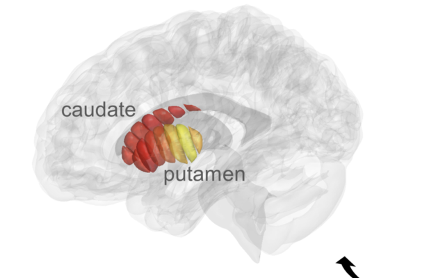 Une image montrant les résultats de l'analyse du cerveau effectuée par l'Université hébraïque pour détecter la maladie de Parkinson. En jaune, les zones de dégradation, qui indiquent le début de la maladie de Parkinson. (Crédit : Laboratoire Mezer/Université hébraïque)