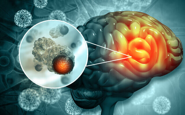 Illustration : Un cerveau humain présentant une croissance cancéreuse. (Crédit : Mohammed Haneefa Nizamudeen ; iStock by Getty Images)