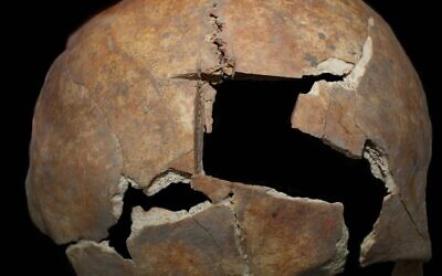 Une vue rapprochée de la procédure de tréphination et du morceau de crâne qui a été retiré découvert à Tel Megiddo, dans le nord d'Israël. (Crédit : Rachel Kalisher)