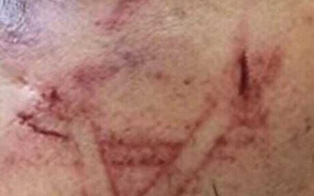 Des marques de coupure sur le visage d'un détenu palestinien qui, selon les forces de l'ordre, ont été causées par la chaussure d'un policier, l'avocat du suspect affirme que la police l'a marqué d'une étoile de David, sur photo publiée par la police le 19 août 2023. (Crédit : Police israélienne)