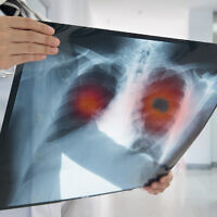 Un médecin détecte un cancer du poumon lors d'un scanner. (Crédit : utah778 via iStock by Getty Images)