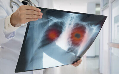 Un médecin détecte un cancer du poumon lors d'un scanner. (Crédit : utah778 via iStock by Getty Images)