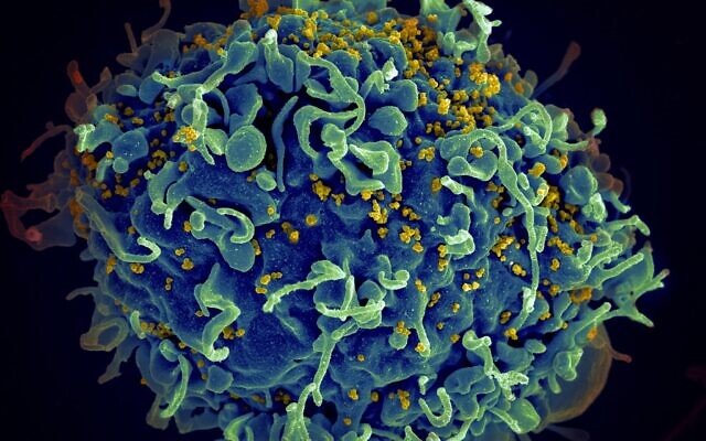 Le virus VIH (en jaune) infectant une cellule humaine. (Crédit : National Cancer Institute on Unsplash/Autorisation de la Touro University)