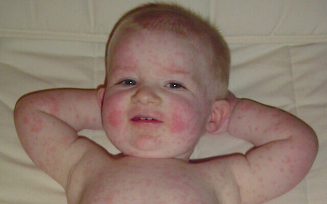 Un enfant de 16 mois atteint de la "cinquième maladie" causée par le parvovirus B19 Illustration (Crédit : Andrew Kerr via Wikimedia Commons)