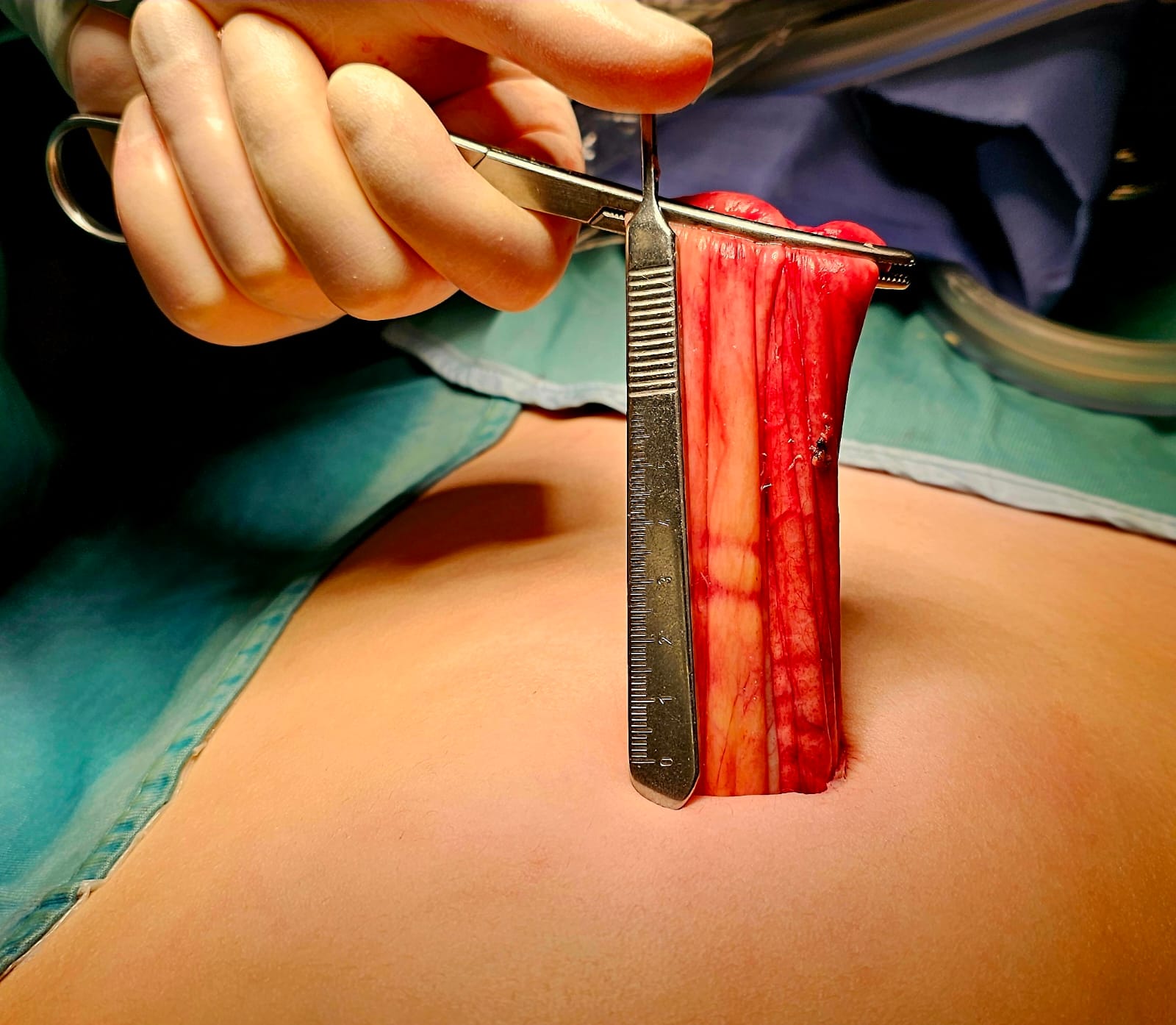 Des chirurgiens d'Ashdod retirent du ventre d'une fillette les ...