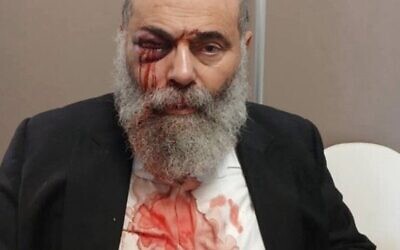 Gilles Cohen, a 67-year-old observant Jew, was attacked on antisemitic grounds on Sep. 27, 2025, in Yerres (Essonne), a suburb south of Paris. (Credit: Cohen’s family)