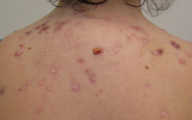 Individual with a case of back acne (Courtesy James Heilman, MD)