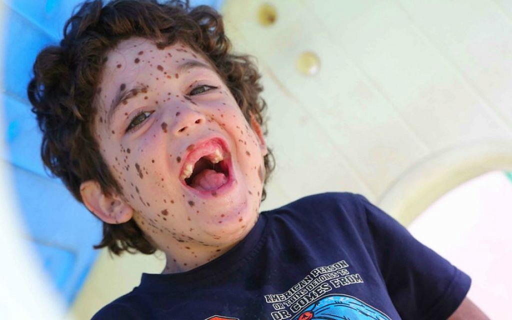 Erez is aged 6 and has a rare skin condition (Photo credit: Rick Guidotti)