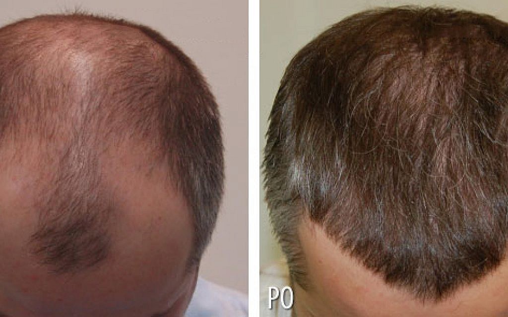 Hair Transplant Results Before and After Hair Transplant Turkey