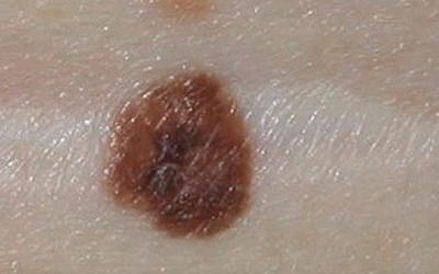 A melanoma lesion (YouTube screenshot)