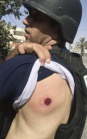 Associated Press photographer Majdi Mohammed shows a bruise after he was hit with a rubber bullet in the West Bank, October 9, 2016. (AP Photo)