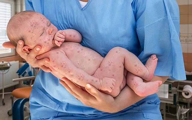 Newborn baby suffering from measles. (Illustrative. iStock by Getty Images/andriano_cz)