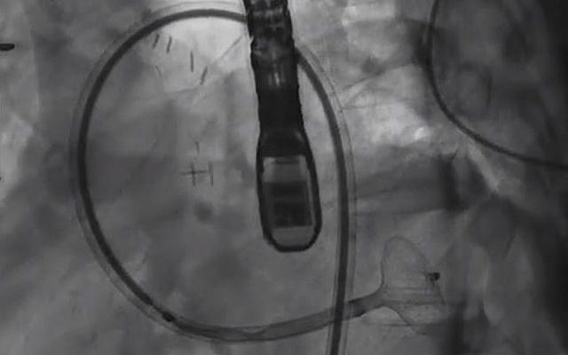 Prof. Victor Guetta, irector of the Invasive and Interventional Cardiology Unit at Sheba Medical Center, plugged a bleeding hole in the artery of a 29-year-old patient using a device that is usually used to unblock arteries (YouTube screenshot)