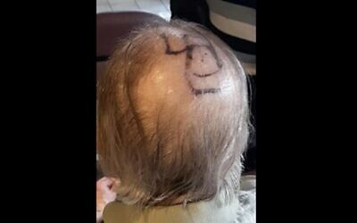 A swastika drawn on the bald head of a Toronto Alzheimer’s patient (Courtesy Shane Morrow)