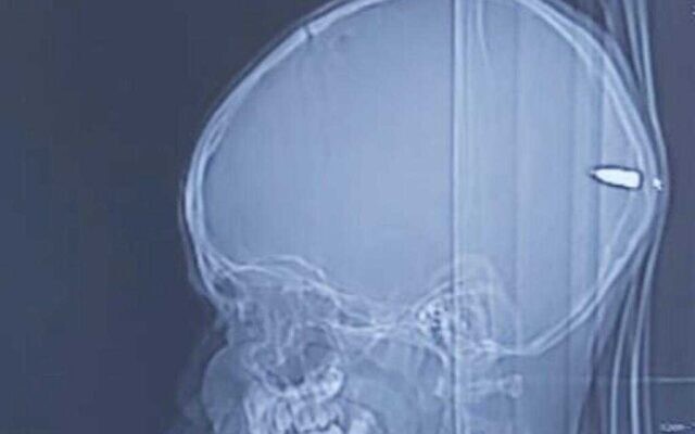 An x-ray image of a bullet lodged in the brain of  9-year-old boy at Hadassah University Hospital in Jerusalem on July 31, 2020 (courtesy of Hadassah University Hospital)