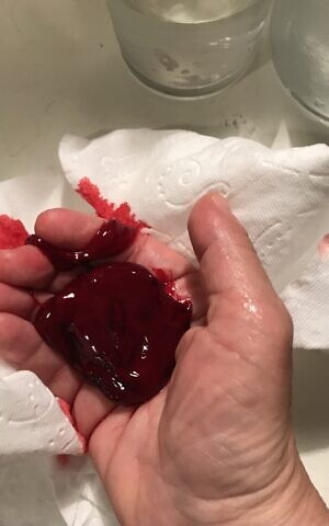 https://static.timesofisrael.com/www/uploads/2021/07/bloody-mass-vaginal-cuff-dehiscence-300x480.jpg