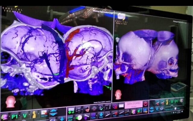 3D imaging of conjoined twins’ heads prior to their separation at Soroka University Medical Center in Beersheba. (Courtesy of Soroka Medical Center)