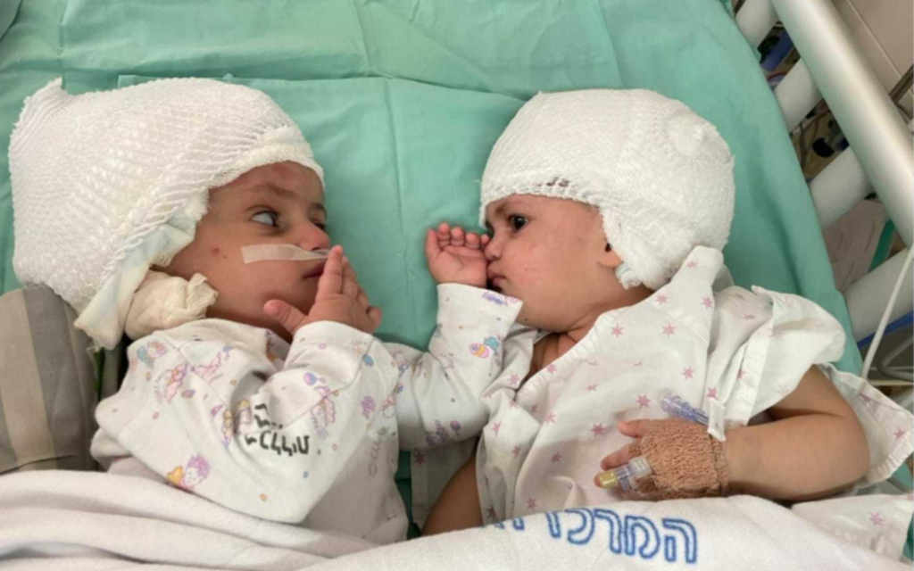 ‘Unbelievable joy’ In Israeli 1st, doctors separate heads of conjoined