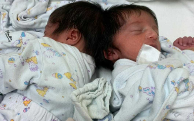 Conjoined twins, photographed before they were separated at Soroka University Medical Center in Beersheba. (courtesy, Soroka University Medical Center)